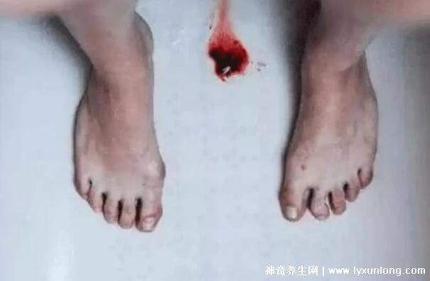 真實(shí)女生內(nèi)膜破壞的圖片,剝脫的子宮內(nèi)膜伴隨經(jīng)血排出-易網(wǎng)健康<a href=http://www.xllyou.com/jkys/ target=_blank class=infotextkey>養(yǎng)生</a>網(wǎng) 真實(shí)女生內(nèi)膜破壞的圖片,剝脫的子宮內(nèi)膜伴隨經(jīng)血排出