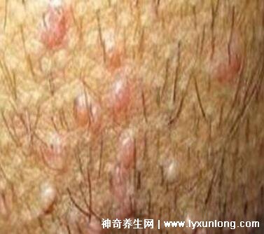 初期尖銳濕尤圖癥狀圖片男性,淡紅色小疙瘩變大為菜花狀疣體-易網(wǎng)健康<a href=http://www.xllyou.com/jkys/ target=_blank class=infotextkey>養(yǎng)生</a>網(wǎng) 初期尖銳濕尤圖癥狀圖片男性,淡紅色小疙瘩變大為菜花狀疣體