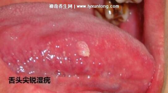 男性早期圖片尖濕銳疣長在哪,生zhi器甚至是口腔(菜花狀疣體出血)-易網健康養生網 男性早期圖片尖濕銳疣長在哪,生zhi器甚至是口腔(菜花狀疣體出血)