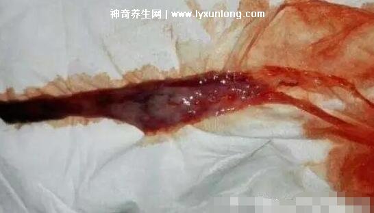 真實(shí)女生內(nèi)膜破壞的圖片，剝脫的子宮內(nèi)膜伴隨經(jīng)血排出