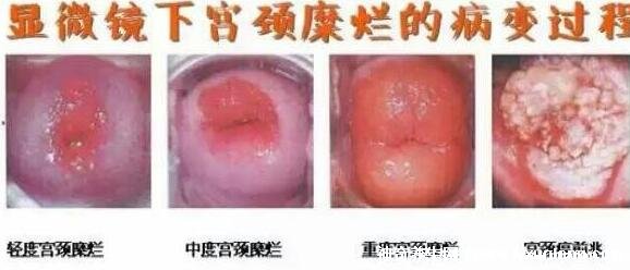 宮頸糜爛一二三度圖片,真實對比照片(小心是宮頸癌前兆)-易網健康<a href=http://www.xllyou.com/jkys/ target=_blank class=infotextkey>養(yǎng)生</a>網 宮頸糜爛一二三度圖片,真實對比照片(小心是宮頸癌前兆)