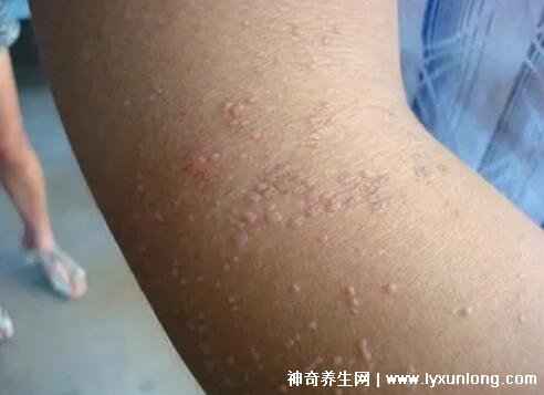 男性疣是什么樣子圖片,尖銳濕疣/扁平疣/絲狀疣發病部位不同-易網健康養生網 男性疣是什么樣子圖片,尖銳濕疣/扁平疣/絲狀疣發病部位不同