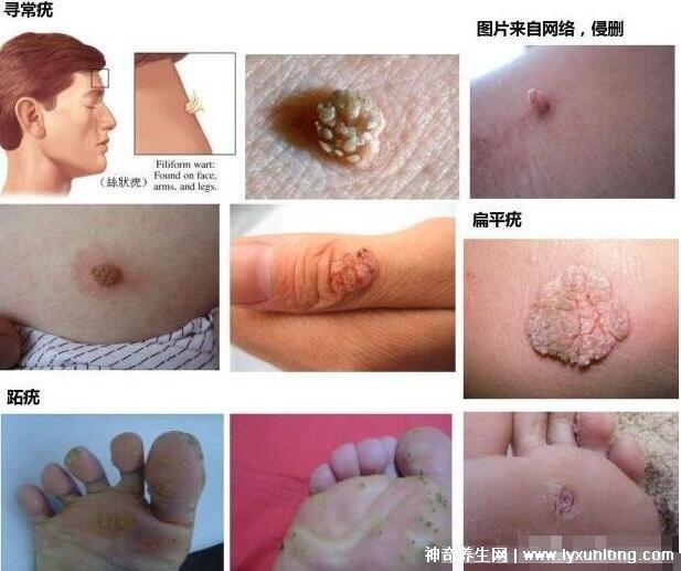 男性疣是什么樣子圖片,尖銳濕疣/扁平疣/絲狀疣發病部位不同-易網健康<a href=http://www.xllyou.com/jkys/ target=_blank class=infotextkey>養生</a>網 男性疣是什么樣子圖片,尖銳濕疣/扁平疣/絲狀疣發病部位不同