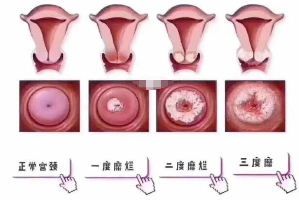 宮頸糜爛一二三度圖片,真實對比照片(小心是宮頸癌前兆)-易網健康養(yǎng)生網 宮頸糜爛一二三度圖片,真實對比照片(小心是宮頸癌前兆)