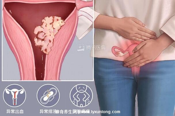 真實宮頸癌的早期出血圖片,接觸性出血是最明顯癥狀(女性必看)-易網健康養生網 真實宮頸癌的早期出血圖片,接觸性出血是最明顯癥狀(女性必看)