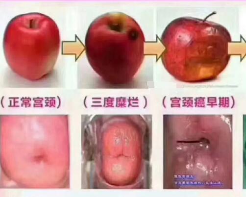 宮頸糜爛一二三度圖片,真實對比照片(小心是宮頸癌前兆)-易網健康養(yǎng)生網 宮頸糜爛一二三度圖片,真實對比照片(小心是宮頸癌前兆)