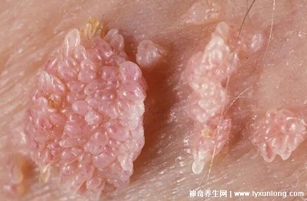 男性疣是什么樣子圖片,尖銳濕疣/扁平疣/絲狀疣發病部位不同-易網健康養生網 男性疣是什么樣子圖片,尖銳濕疣/扁平疣/絲狀疣發病部位不同