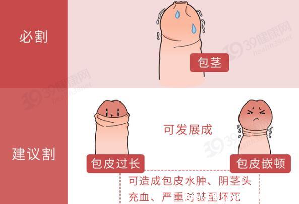 成年男子割包好處和壞處,8種情況必須割(附割包照片真實)-易網健康<a href=http://www.xllyou.com/jkys/ target=_blank class=infotextkey>養生</a>網 成年男子割包好處和壞處,8種情況必須割(附割包照片真實)