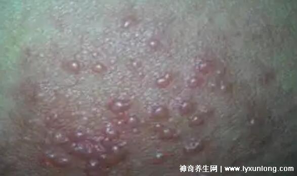 男性疣是什么樣子圖片,尖銳濕疣/扁平疣/絲狀疣發病部位不同-易網<a href=http://www.xllyou.com/ target=_blank class=infotextkey>健康養生</a>網 男性疣是什么樣子圖片,尖銳濕疣/扁平疣/絲狀疣發病部位不同