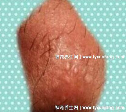 男性早期圖片尖濕銳疣長在哪,生zhi器甚至是口腔(菜花狀疣體出血)-易網健康養生網 男性早期圖片尖濕銳疣長在哪,生zhi器甚至是口腔(菜花狀疣體出血)