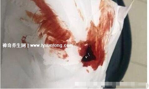 真實(shí)女生內(nèi)膜破壞的圖片,剝脫的子宮內(nèi)膜伴隨經(jīng)血排出-易網(wǎng)健康養(yǎng)生網(wǎng) 真實(shí)女生內(nèi)膜破壞的圖片,剝脫的子宮內(nèi)膜伴隨經(jīng)血排出