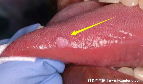 男性早期圖片尖濕銳疣長在哪,生zhi器甚至是口腔(菜花狀疣體出血)-易網健康養生網 男性早期圖片尖濕銳疣長在哪,生zhi器甚至是口腔(菜花狀疣體出血)