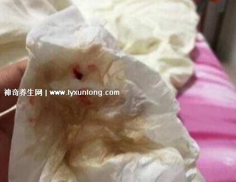 真實宮頸癌的早期出血圖片,接觸性出血是最明顯癥狀(女性必看)-易網健康養生網 真實宮頸癌的早期出血圖片,接觸性出血是最明顯癥狀(女性必看)