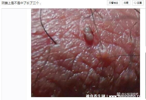 男性早期圖片尖濕銳疣長在哪,生zhi器甚至是口腔(菜花狀疣體出血)-易網健康養生網 男性早期圖片尖濕銳疣長在哪,生zhi器甚至是口腔(菜花狀疣體出血)