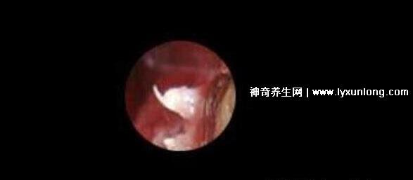 初期女士濕銳疣圖片早期,口腔尖銳濕癥狀太嚇人了(菜花樣疣體)-易網健康<a href=http://www.xllyou.com/jkys/ target=_blank class=infotextkey>養生</a>網 初期女士濕銳疣圖片早期,口腔尖銳濕癥狀太嚇人了(菜花樣疣體)