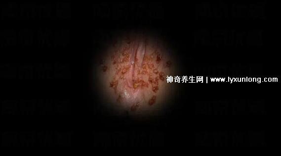 初期女士濕銳疣圖片早期,口腔尖銳濕癥狀太嚇人了(菜花樣疣體)-易網健康養生網 初期女士濕銳疣圖片早期,口腔尖銳濕癥狀太嚇人了(菜花樣疣體)