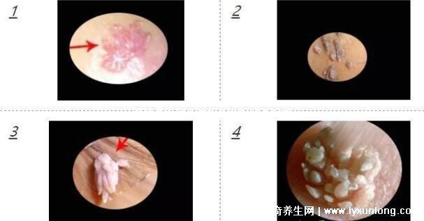 男性早期圖片尖濕銳疣長在哪,生zhi器甚至是口腔(菜花狀疣體出血)-易網健康養生網 男性早期圖片尖濕銳疣長在哪,生zhi器甚至是口腔(菜花狀疣體出血)