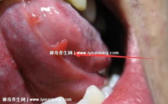 初期女士濕銳疣圖片早期,口腔尖銳濕癥狀太嚇人了(菜花樣疣體)-易網健康養生網 初期女士濕銳疣圖片早期,口腔尖銳濕癥狀太嚇人了(菜花樣疣體)