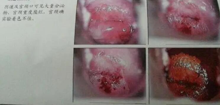 宮頸糜爛一二三度圖片,真實對比照片(小心是宮頸癌前兆)-易網健康養(yǎng)生網 宮頸糜爛一二三度圖片,真實對比照片(小心是宮頸癌前兆)
