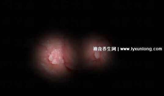 初期女士濕銳疣圖片早期,口腔尖銳濕癥狀太嚇人了(菜花樣疣體)-易網健康養生網 初期女士濕銳疣圖片早期,口腔尖銳濕癥狀太嚇人了(菜花樣疣體)