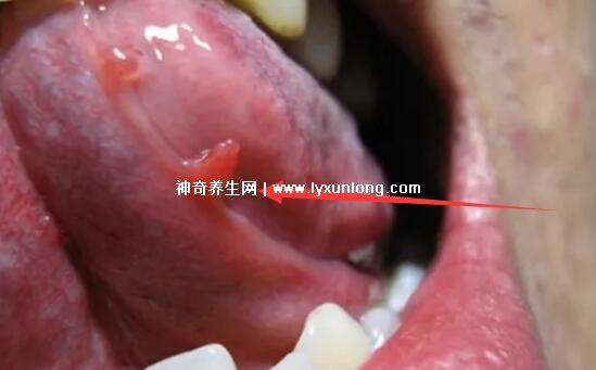 男性疣是什么樣子圖片,尖銳濕疣/扁平疣/絲狀疣發病部位不同-易網健康養生網 男性疣是什么樣子圖片,尖銳濕疣/扁平疣/絲狀疣發病部位不同