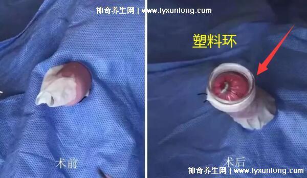 成年男子割包好處和壞處,8種情況必須割(附割包照片真實)-易網健康養生網 成年男子割包好處和壞處,8種情況必須割(附割包照片真實)