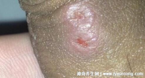 男性疣是什么樣子圖片,尖銳濕疣/扁平疣/絲狀疣發病部位不同-易網健康養生網 男性疣是什么樣子圖片,尖銳濕疣/扁平疣/絲狀疣發病部位不同