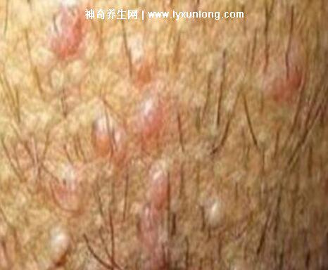 男性早期圖片尖濕銳疣長在哪,生zhi器甚至是口腔(菜花狀疣體出血)-易網<a href=http://www.xllyou.com/ target=_blank class=infotextkey>健康養生</a>網 男性早期圖片尖濕銳疣長在哪,生zhi器甚至是口腔(菜花狀疣體出血)