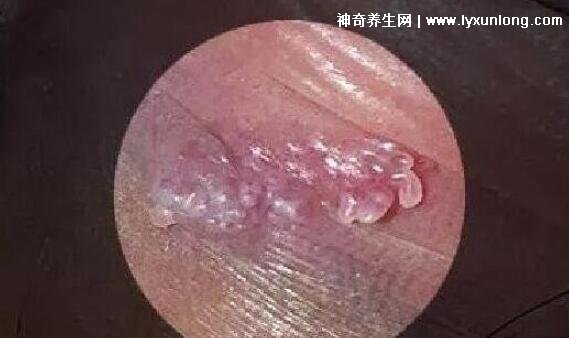 初期女士濕銳疣圖片早期,口腔尖銳濕癥狀太嚇人了(菜花樣疣體)-易網健康養生網 初期女士濕銳疣圖片早期,口腔尖銳濕癥狀太嚇人了(菜花樣疣體)