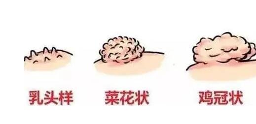 初期尖銳濕尤圖癥狀圖片男性,淡紅色小疙瘩變大為菜花狀疣體-易網(wǎng)<a href=http://www.xllyou.com/ target=_blank class=infotextkey>健康養(yǎng)生</a>網(wǎng) 初期尖銳濕尤圖癥狀圖片男性,淡紅色小疙瘩變大為菜花狀疣體