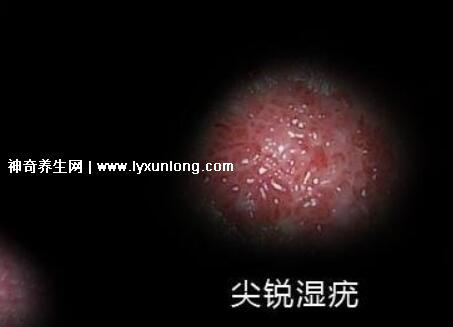 初期女士濕銳疣圖片早期,口腔尖銳濕癥狀太嚇人了(菜花樣疣體)-易網<a href=http://www.xllyou.com/ target=_blank class=infotextkey>健康養生</a>網 初期女士濕銳疣圖片早期,口腔尖銳濕癥狀太嚇人了(菜花樣疣體)