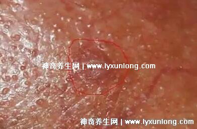男性早期圖片尖濕銳疣長在哪,生zhi器甚至是口腔(菜花狀疣體出血)-易網健康<a href=http://www.xllyou.com/jkys/ target=_blank class=infotextkey>養生</a>網 男性早期圖片尖濕銳疣長在哪,生zhi器甚至是口腔(菜花狀疣體出血)