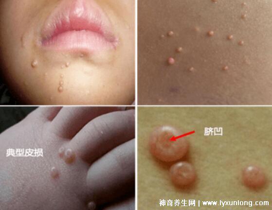 男性疣是什么樣子圖片,尖銳濕疣/扁平疣/絲狀疣發病部位不同-易網健康養生網 男性疣是什么樣子圖片,尖銳濕疣/扁平疣/絲狀疣發病部位不同