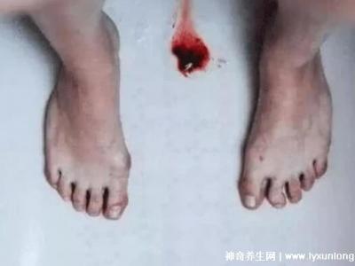 真實(shí)女生內(nèi)膜破壞的圖片，剝脫的子宮內(nèi)膜伴隨經(jīng)血排出