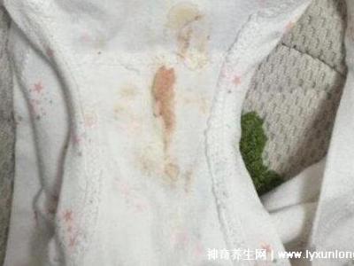 宮頸癌褐色分泌物圖片，少量不規則出血伴隨X交痛(腥臭分泌物)