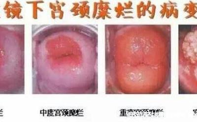宮頸糜爛一二三度圖片，真實對比照片(小心是宮頸癌前兆)