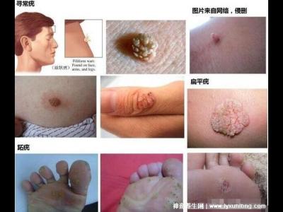 用了甲硝唑后里面長滿了霉菌，破壞有益菌群/衛生不佳(附治療法)