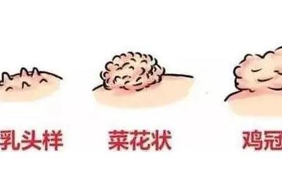初期尖銳濕尤圖癥狀圖片男性，淡紅色小疙瘩變大為菜花狀疣體
