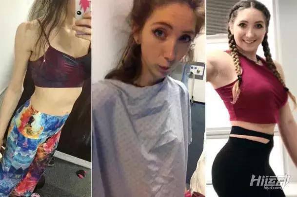 極致追求瘦身，反而患上疾病，一天嘔吐14次