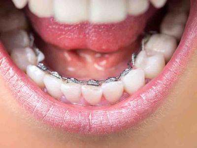 飯后刷牙真的能減肥嗎