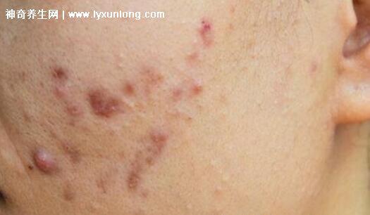 閉口粉刺真正的圖片,粗糙的顆粒會發炎長膿皰(黑頭也是粉刺)-易網健康養生網 閉口粉刺真正的圖片,粗糙的顆粒會發炎長膿皰(黑頭也是粉刺)