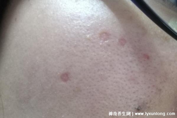 千萬不要激光點痣后悔一輩子,可導致惡性黑色素瘤(共3個危害)-易網健康<a href=http://www.xllyou.com/jkys/ target=_blank class=infotextkey>養生</a>網 千萬不要激光點痣后悔一輩子,可導致惡性黑色素瘤(共3個危害)