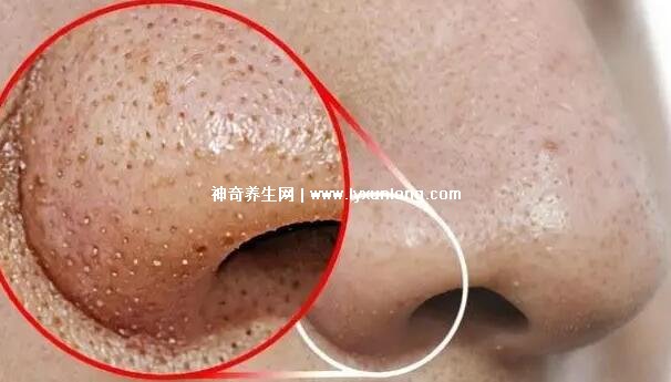 閉口粉刺真正的圖片,粗糙的顆粒會發炎長膿皰(黑頭也是粉刺)-易網健康<a href=http://www.xllyou.com/jkys/ target=_blank class=infotextkey>養生</a>網 閉口粉刺真正的圖片,粗糙的顆粒會發炎長膿皰(黑頭也是粉刺)