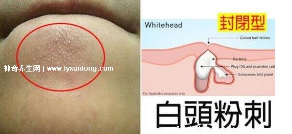 閉口粉刺真正的圖片,粗糙的顆粒會發炎長膿皰(黑頭也是粉刺)-易網健康養生網 閉口粉刺真正的圖片,粗糙的顆粒會發炎長膿皰(黑頭也是粉刺)