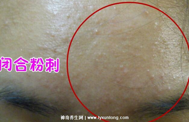 閉口粉刺真正的圖片,粗糙的顆粒會發炎長膿皰(黑頭也是粉刺)-易網健康養生網 閉口粉刺真正的圖片,粗糙的顆粒會發炎長膿皰(黑頭也是粉刺)