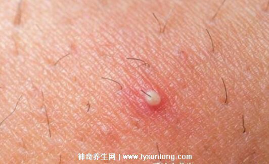 閉口粉刺真正的圖片，粗糙的顆粒會發炎長膿皰(黑頭也是粉刺)