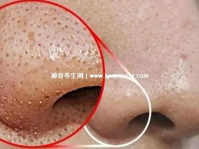 閉口粉刺真正的圖片，粗糙的顆粒會發炎長膿皰(黑頭也是粉刺)