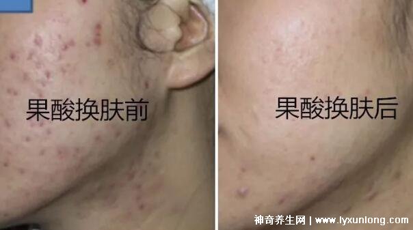 果酸換膚多少錢一次,1000-3000元不等(細致毛孔/淡化痘印)-易網健康<a href=http://www.xllyou.com/jkys/ target=_blank class=infotextkey>養生</a>網 果酸換膚多少錢一次,1000-3000元不等(細致毛孔/淡化痘印)