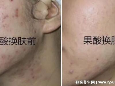 果酸換膚多少錢一次，1000-3000元不等(細致毛孔/淡化痘印)