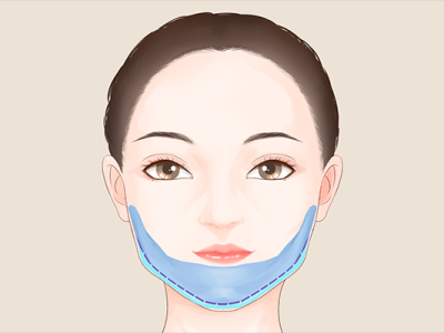 如何減掉雙下巴妙招